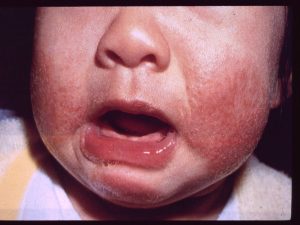 baby-eczema-on-face